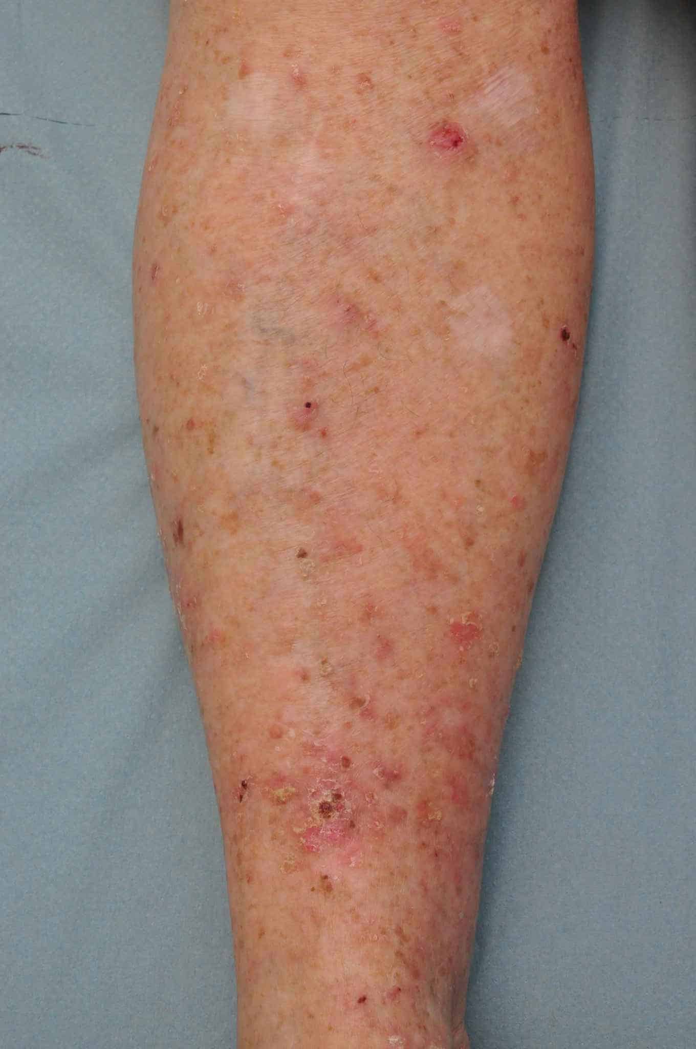 Billede af aktinisk keratose