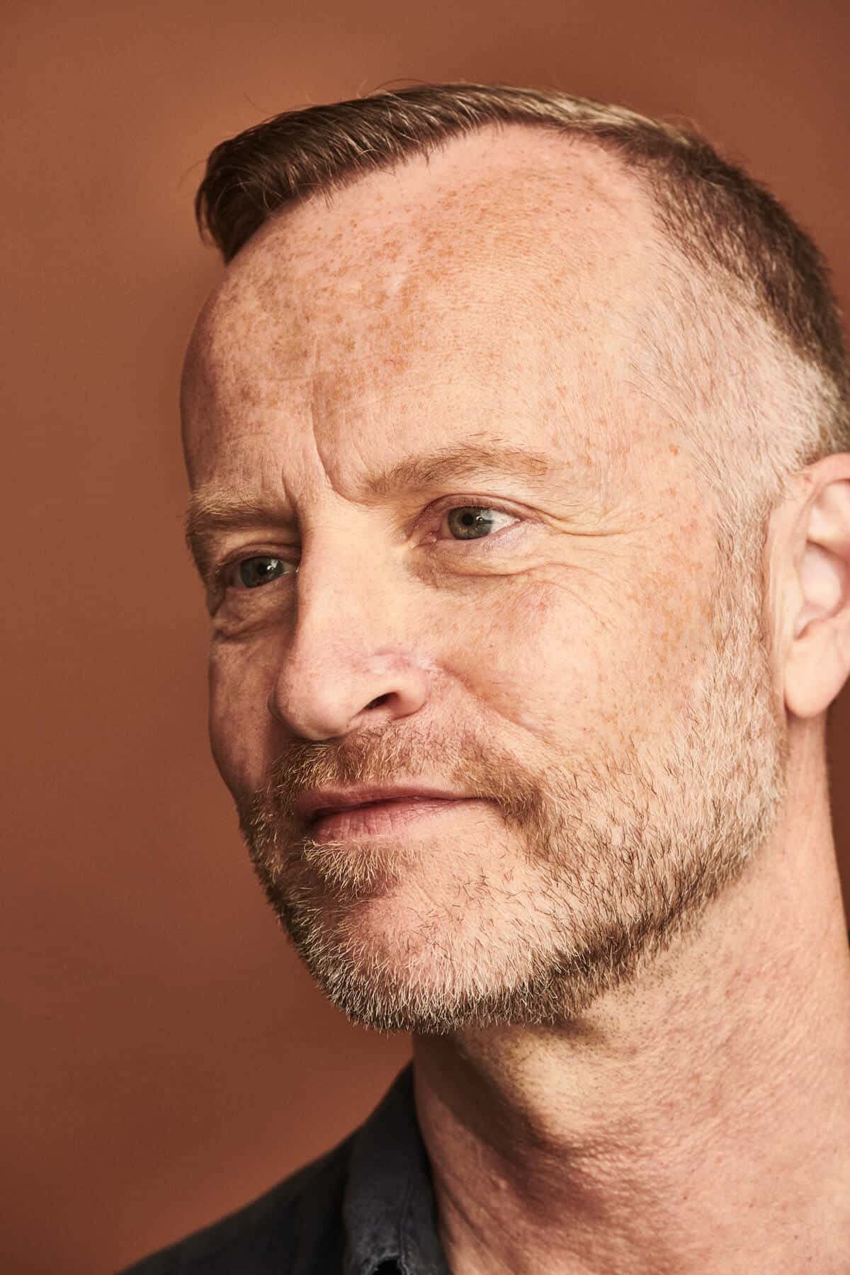 Patient behandlet med Mohs kirurgi på næsen