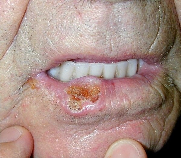 Billede af Pladecellekræft