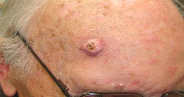 Billede af Pladecellekræft