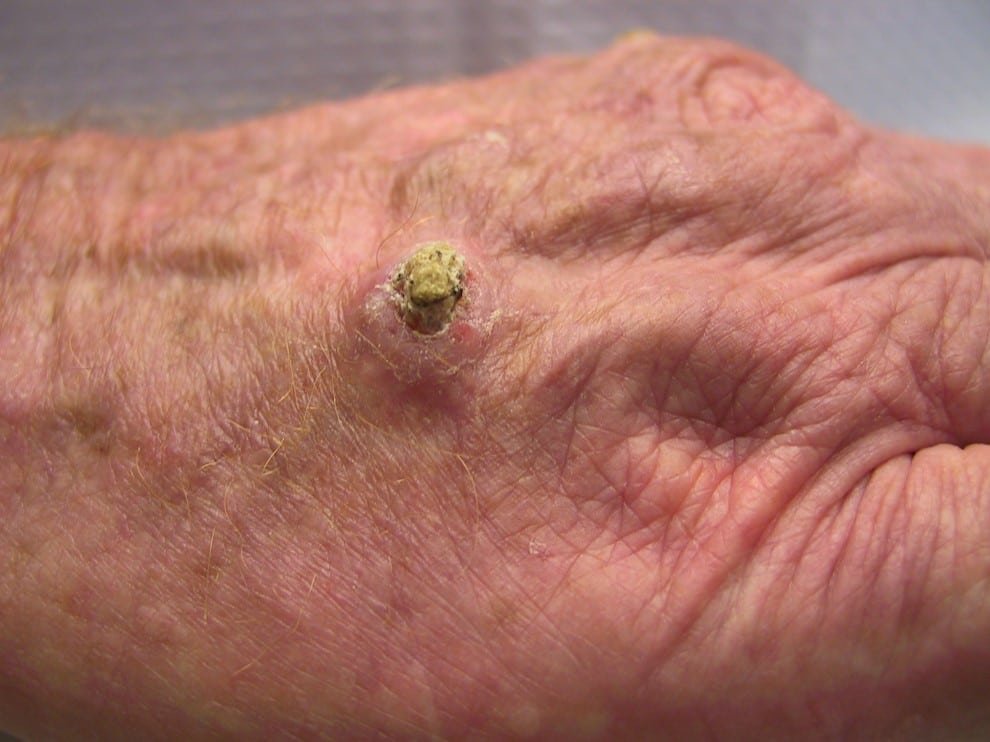 Billede af Pladecellekræft